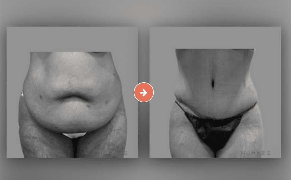 Panniculectomy Before and After Pictures Charleston County, SC