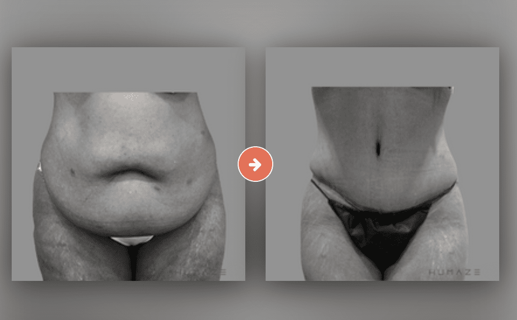 Panniculectomy Vs. Abdominoplasty (Tummy Tuck): Understanding the