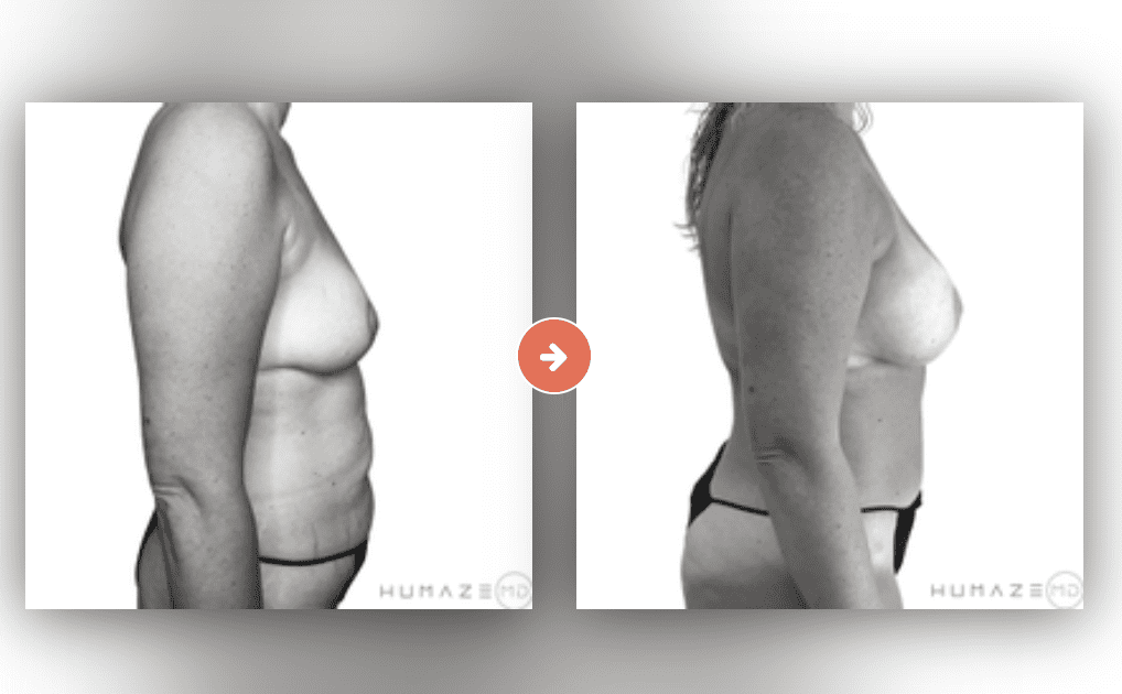 Screenshot 2023-10-12 at 6.56.47 PM Mommy Makeover Before and After Pictures Charleston County, SC