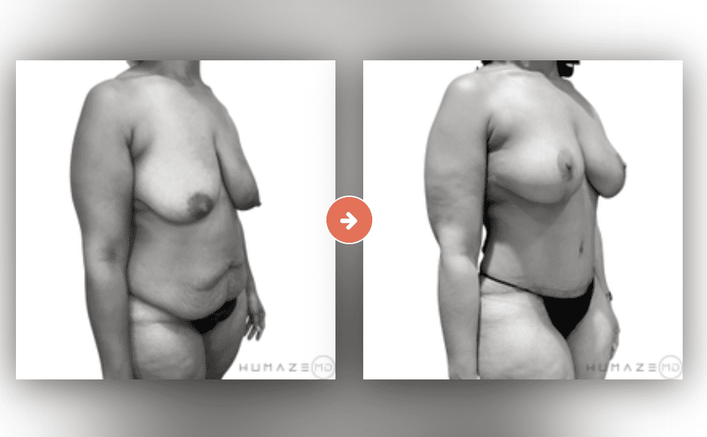Screenshot 2023-10-12 at 6.57.04 PM Mommy Makeover Before and After Pictures Charleston County, SC