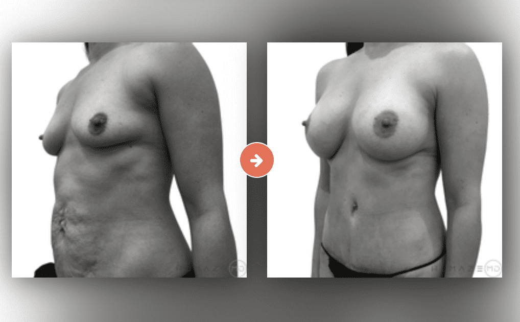 Screenshot 2023-10-12 at 6.57.20 PM Mommy Makeover Before and After Pictures Charleston County, SC