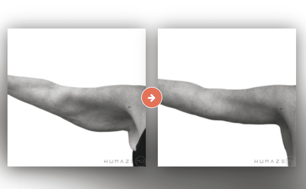 Screenshot 2023-10-12 at 6.58.21 PM Brachioplasty (Arm Lift) Before and After Pictures Charleston County, SC