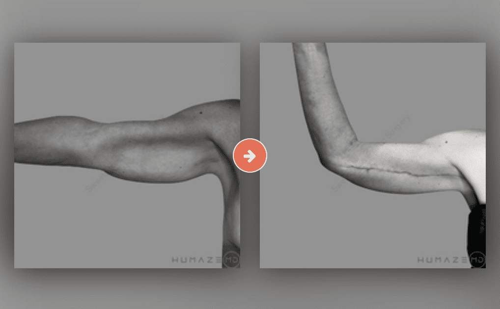 Brachioplasty (Arm Lift) Before and After Pictures Charleston County, SC