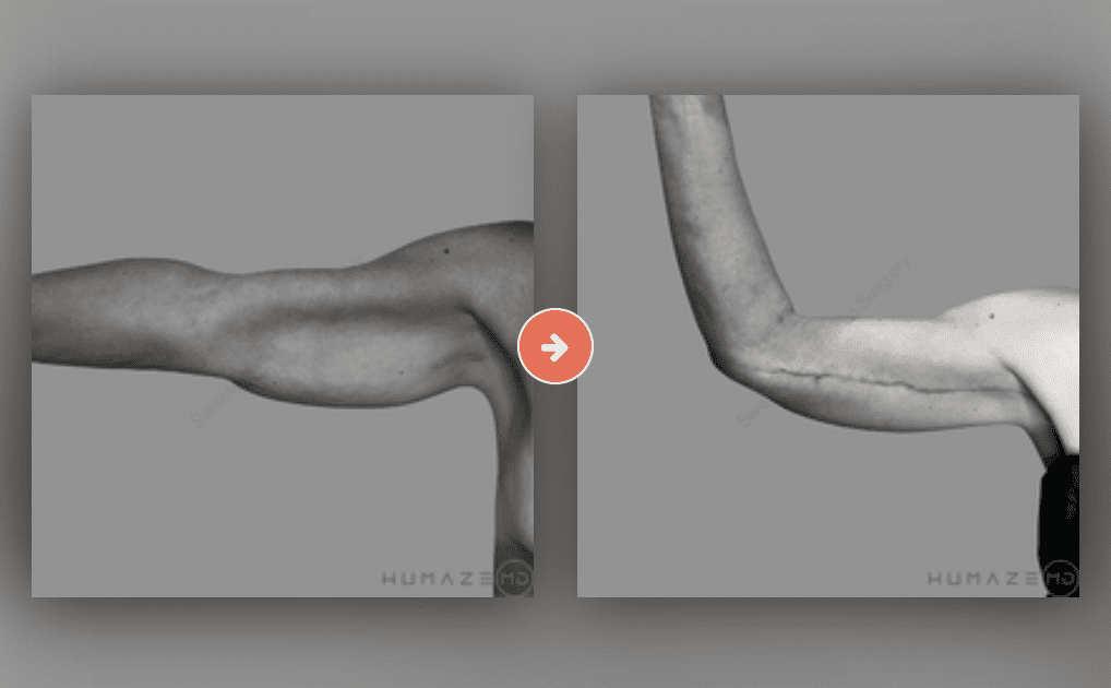 Screenshot 2023-10-12 at 6.58.37 PM Brachioplasty (Arm Lift) Before and After Pictures Charleston County, SC