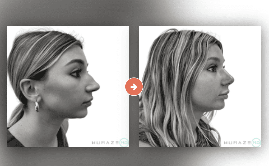 Rhinoplasty Before and After Pictures Charleston County, SC