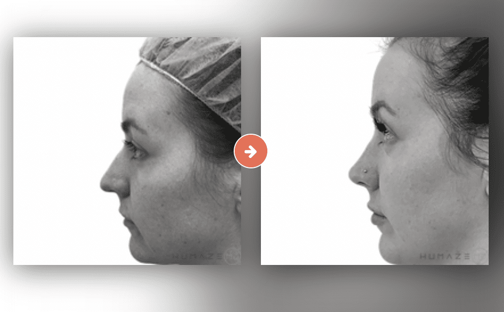 Rhinoplasty Before and After Pictures Charleston County, SC