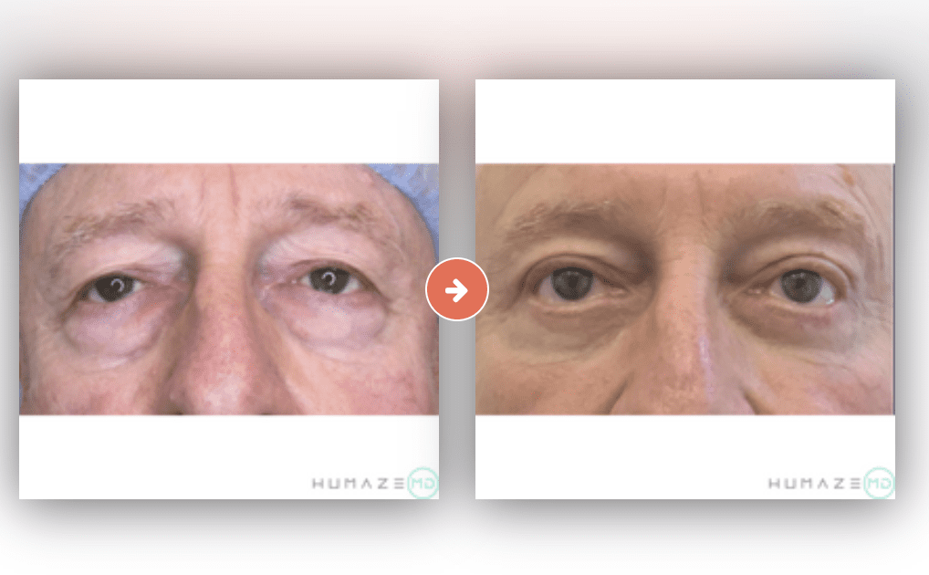 Blepharoplasty (Eyelid Surgery) Before and After Pictures Charleston County, SC