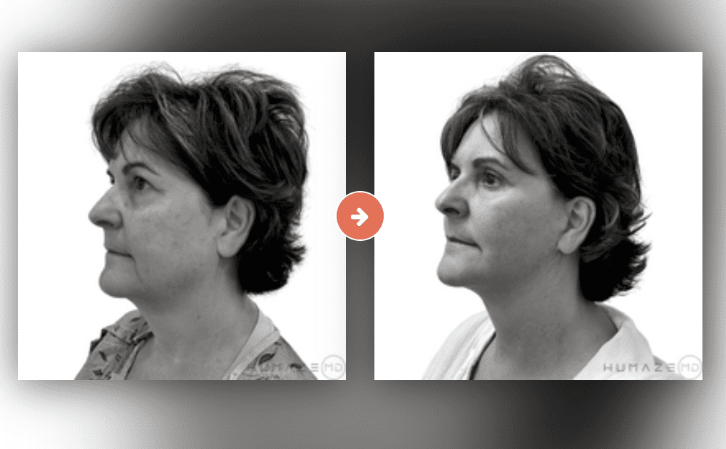 Facelift Before and After Pictures Charleston County, SC