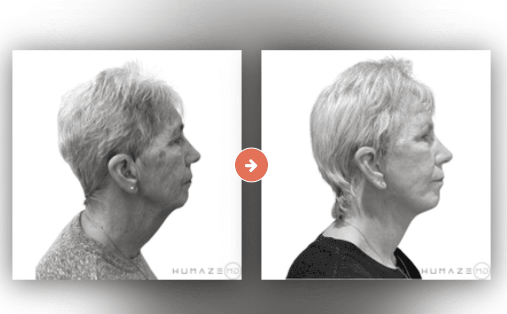 Facelift Before and After Pictures Charleston County, SC