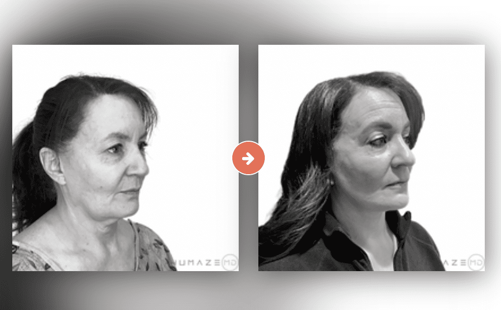 Facelift Before and After Pictures Charleston County, SC