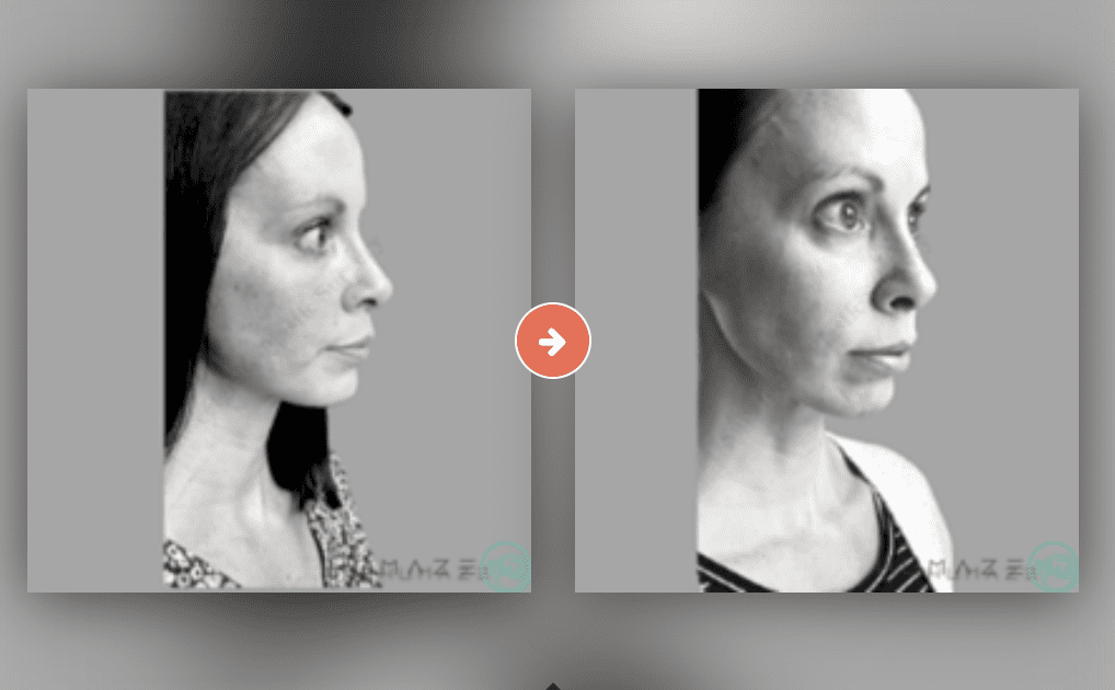 Screenshot 2023-10-13 at 2.28.09 PM Laser Treatments Before and After Pictures Charleston County, SC