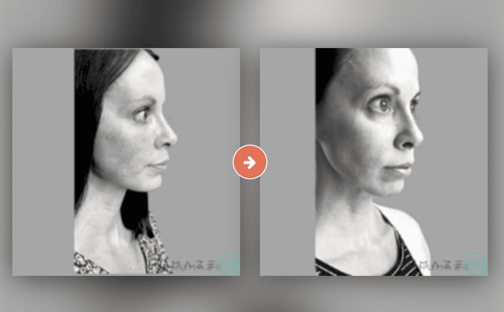 Facials Before and After Pictures Charleston County, SC