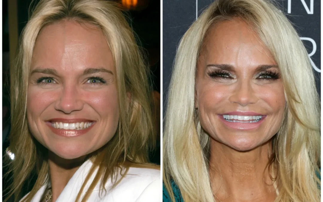 Did Kristen Chenoweth Have Plastic Surgery?