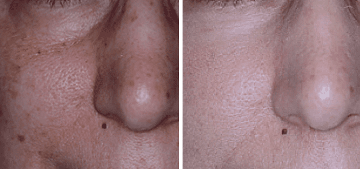 Aerolase Laser Before and After Pictures Charleston County, SC