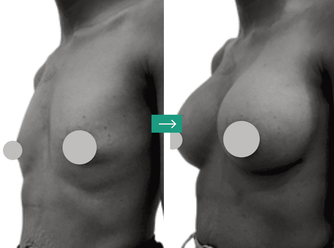 Aerolase Laser Before and After Pictures Charleston County, SC