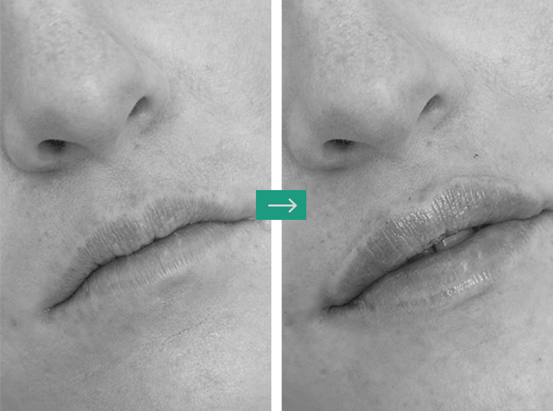Aerolase Laser Before and After Pictures Charleston County, SC