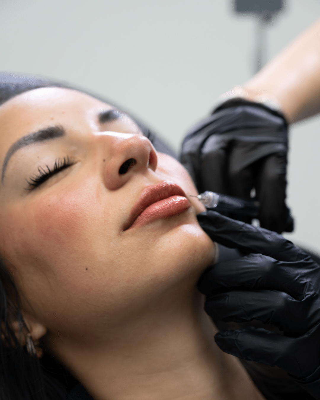 Close-up of a woman receiving lip filler injections; a clinician in black gloves injects near her lips.