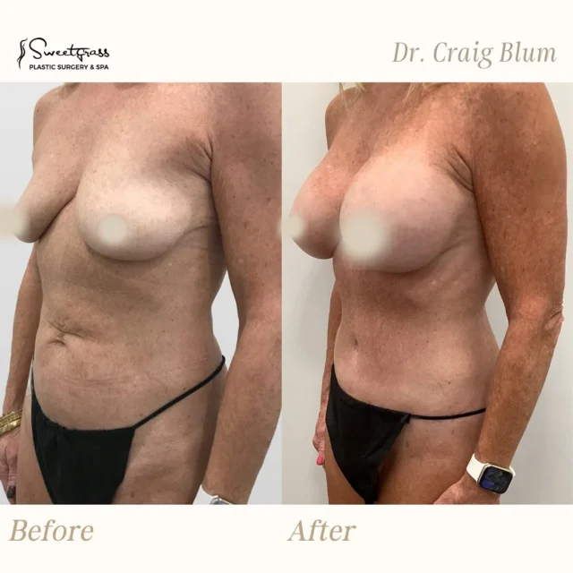 ✨ MOMMY MAKEOVER by Dr. Blum Amazing results and our patient is thrilled after her surgery! Take advantage now of our Mother’s Day Special that is still happening! 🌸 Here are the details: ✨ 25% OFF the surgeon’s fee for any Mommy Makeover Combo
✨ Breast Augmentation Special – only $6995 📅 Book your consultation and secure your deposit by June 30th
🗓️ Surgery must be completed by August 31st Ready to book a complimentary consultation? Call or DM us today! #charlestonplasticsurgery #charlestonsc #mommymakeover #beforeandafter #drblum