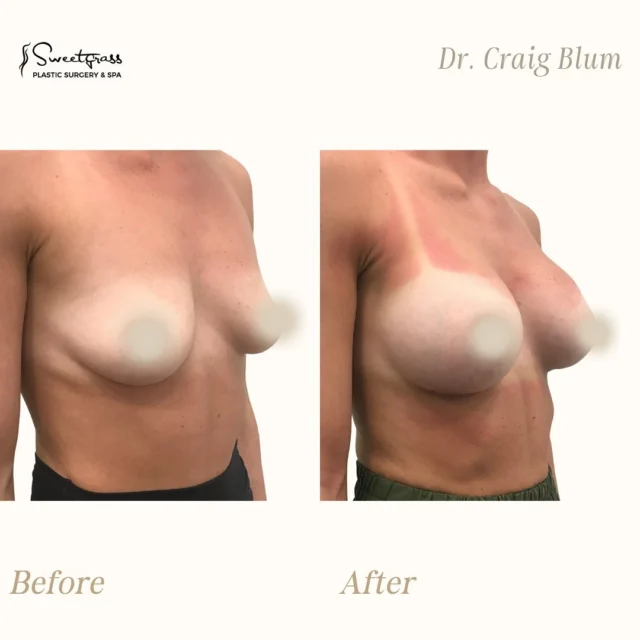 Amazing before and after Breast Augmentation by Dr. Craig Blum! 🌟 Our patient desired a fuller, more proportionate upper body while maintaining a natural shape. 🌸 Our Mother’s Day Special is still happening! Take advantage while you can. Here are the details: ✨ 25% OFF the surgeon’s fee for any Mommy Makeover Combo
✨ Breast Augmentation Special – only $6995 📅 Book your consultation and secure your deposit by June 30th
🗓️ Surgery must be completed by August 31st Ready to book a complimentary consultation? Call or DM us today! #breastaugmentation #sweetgrassplasticsurgery #beforeandafter #drblum #charlestonsc