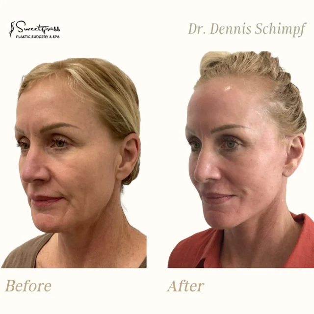 5 weeks post-op and the transformation speaks for itself ✨ This patient is glowing after a deep plane lower face + necklift, CO2 laser, Morpheus8, and ViPeel — all customized to restore natural contours and refine skin texture.We’re thrilled she’s loving her results! Interested in coming in for a complimentary consultation with Dr. Schimpf? Let’s get you booked today! 🌟 #charlestonplasticsurgery #facelift #sweetgrassplasticsurgery #charlestonsc #beforeandafter